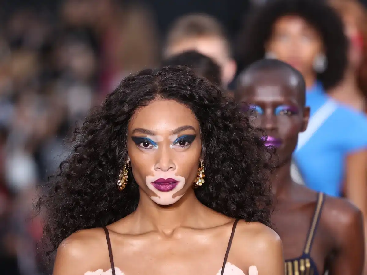 Winnie Harlow Net Worth, Age, Bio, Height, Sister, Parents, Skin